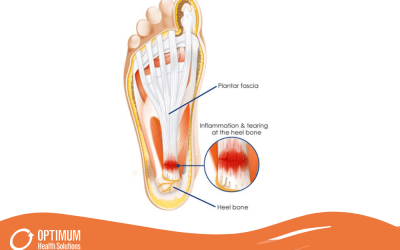 can dry needling help plantar fasciitis