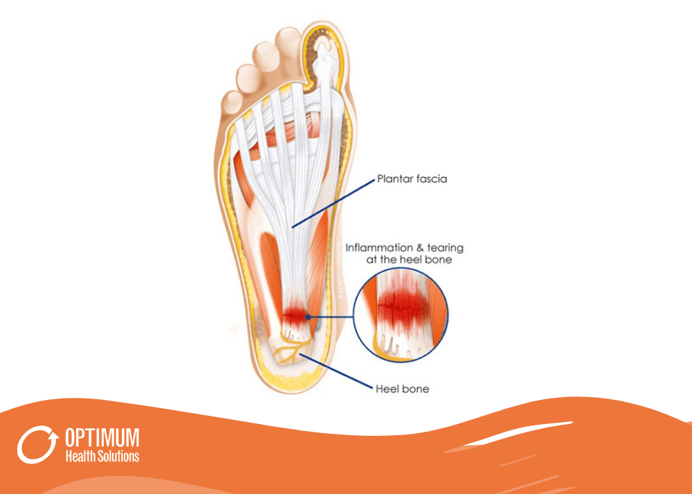 can dry needling help plantar fasciitis